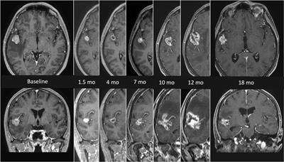 Frontiers | Modern Radiation Therapy For The Management Of Brain ...